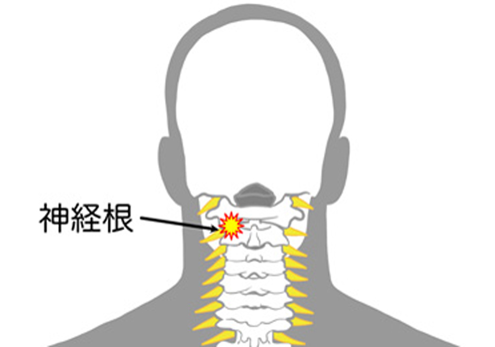 神経根損傷