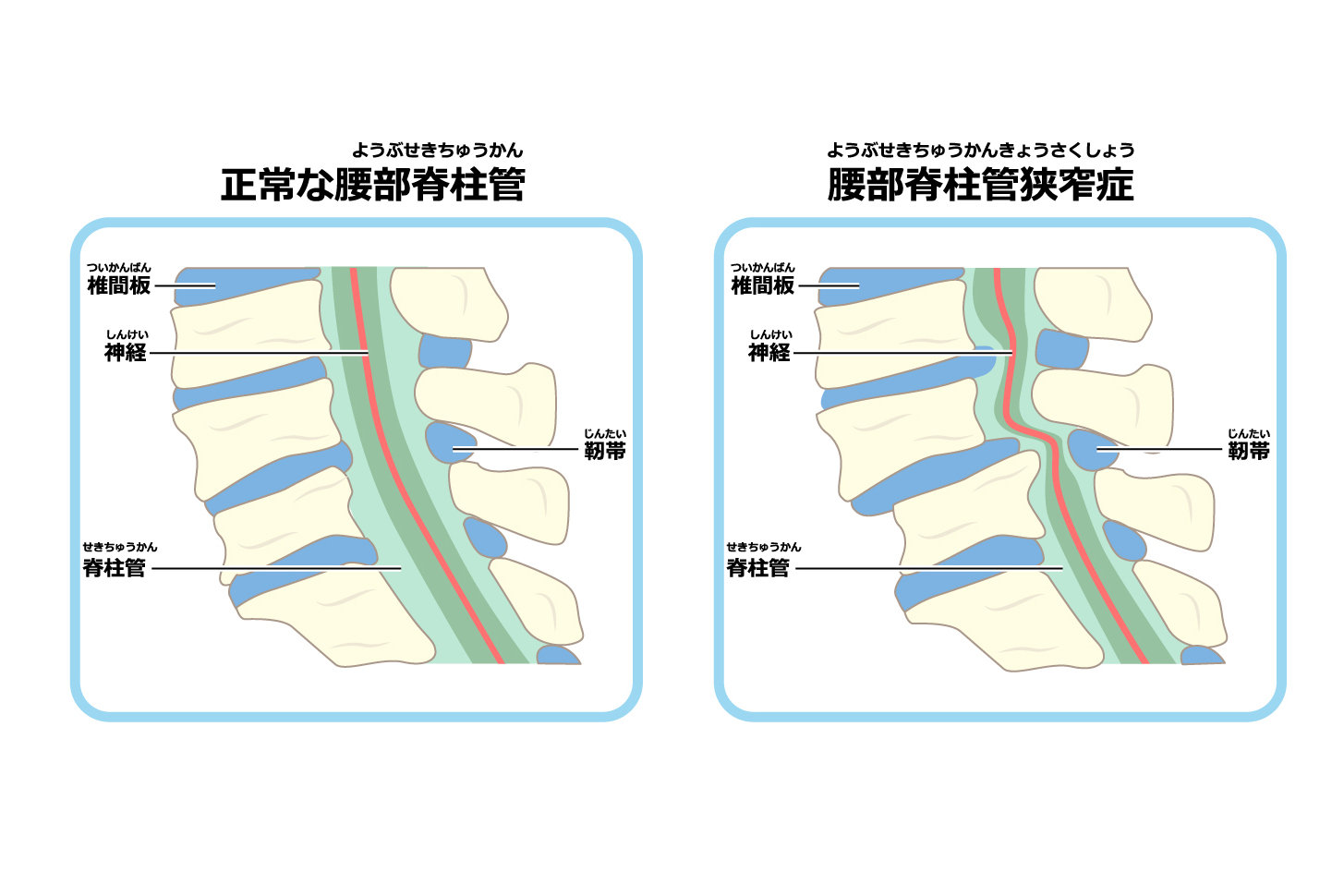 腰部脊柱管狭窄症とは？