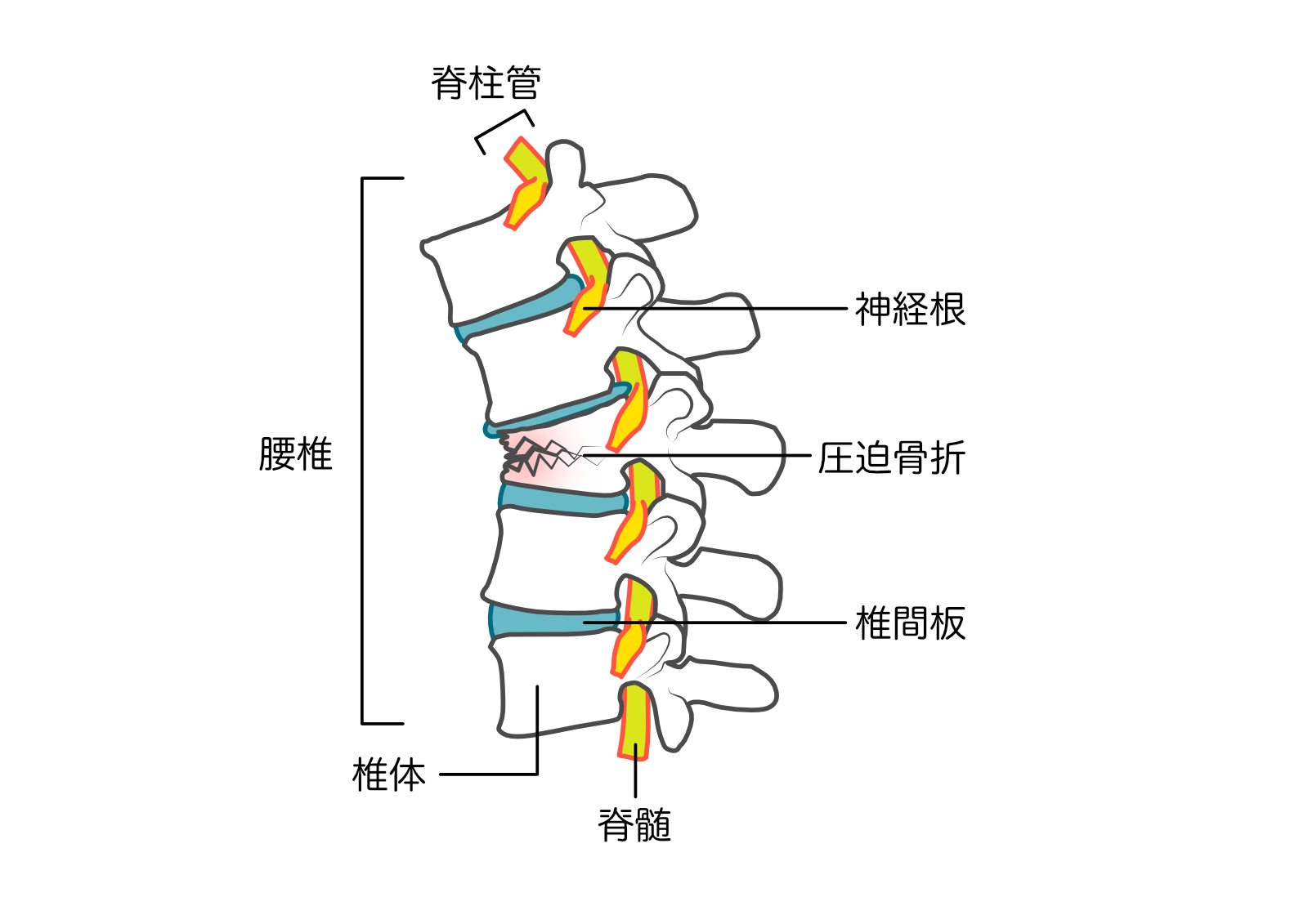 骨粗しょう症（腰椎圧迫骨折）