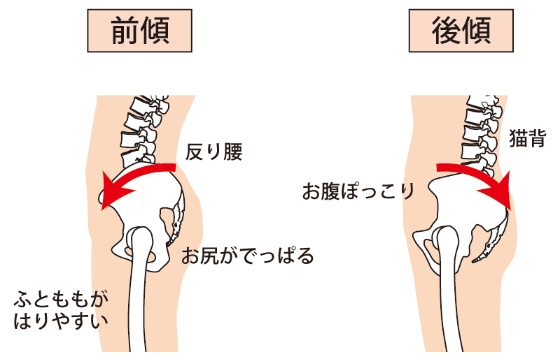 前傾のゆがみ